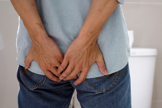 Hemorrhoids (Piles)